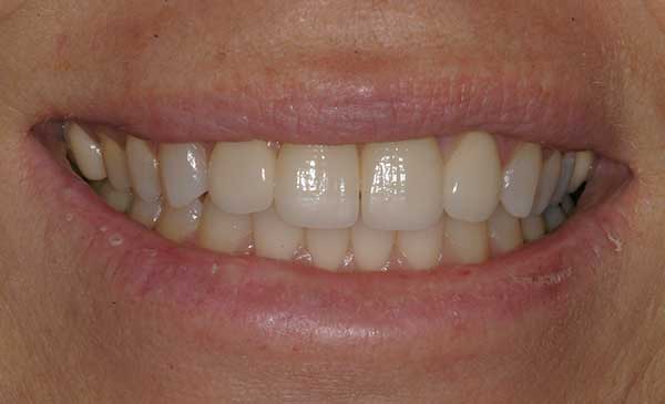 Close-up of upper front teeth showing dental work and gum line against pink lips.