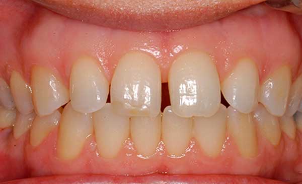 Close-up of upper front teeth showing natural tooth color and dental alignment in mouth.