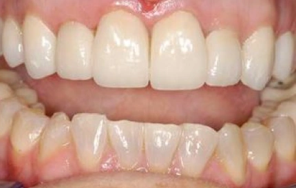 After composite bonding to repair chipped front teeth at Oregon Smile Care Center