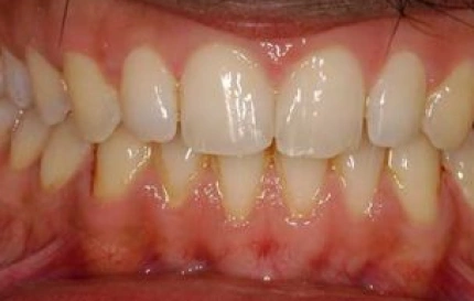 After cosmetic dental bonding for front tooth gap closure at Oregon Smile Care Center