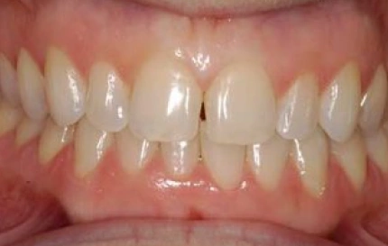 After cosmetic dentistry restoring front teeth at Oregon Smile Care Center