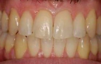 After Invisalign teeth straightening treatment at Oregon Smile Care Center