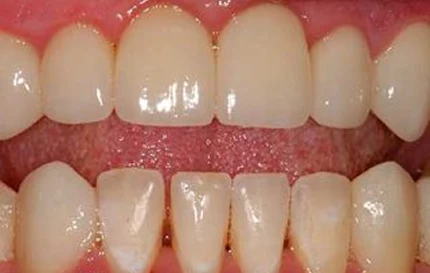 After dental restoration with healthy, natural-looking front teeth and improved smile.