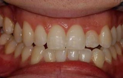 After porcelain veneers smile makeover at Oregon Smile Care Center