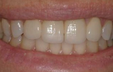 After professional teeth whitening treatment at Oregon Smile Care Center