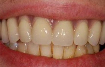 After treatment restoring teeth affected by severe tooth decay at Oregon Smile Care Center