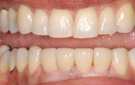After smile rehabilitation with cosmetic restoration at Oregon Smile Care Center