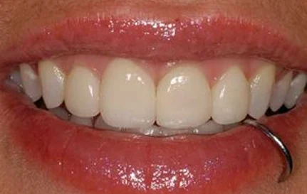 After smile makeover with brighter, straighter, and healthier-looking teeth.