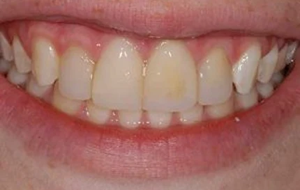After cosmetic dental treatment with aligned, natural-looking front teeth.