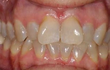 Before composite bonding to repair chipped front teeth at Oregon Smile Care Center