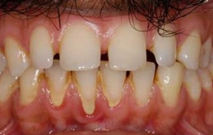 Before cosmetic dental bonding for front tooth gap closure at Oregon Smile Care Center
