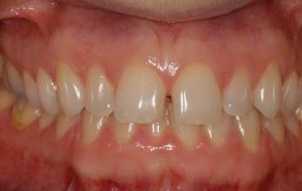 Before cosmetic dentistry restoring front teeth at Oregon Smile Care Center
