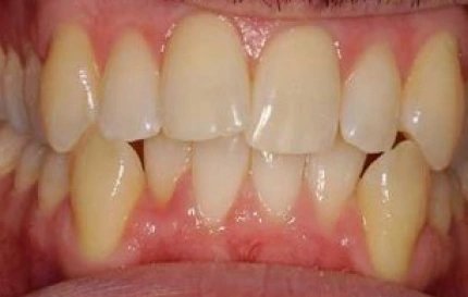 Before Invisalign teeth straightening treatment at Oregon Smile Care Center