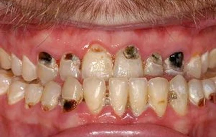 Before dental restoration showing severely decayed and damaged upper front teeth.