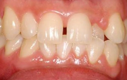 Before porcelain veneers smile makeover at Oregon Smile Care Center