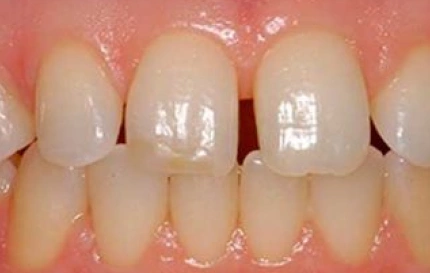 Before professional teeth whitening treatment at Oregon Smile Care Center