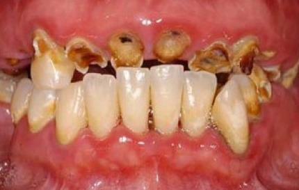 Before treatment for severe tooth decay at Oregon Smile Care Center