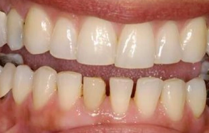 Before smile rehabilitation with cosmetic restoration at Oregon Smile Care Center