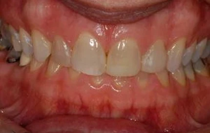 Before smile makeover with worn and discolored front teeth.