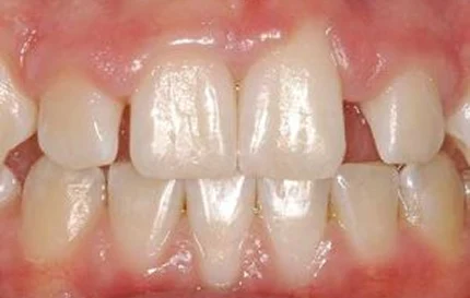 Before cosmetic dentistry with chipped and uneven front teeth.