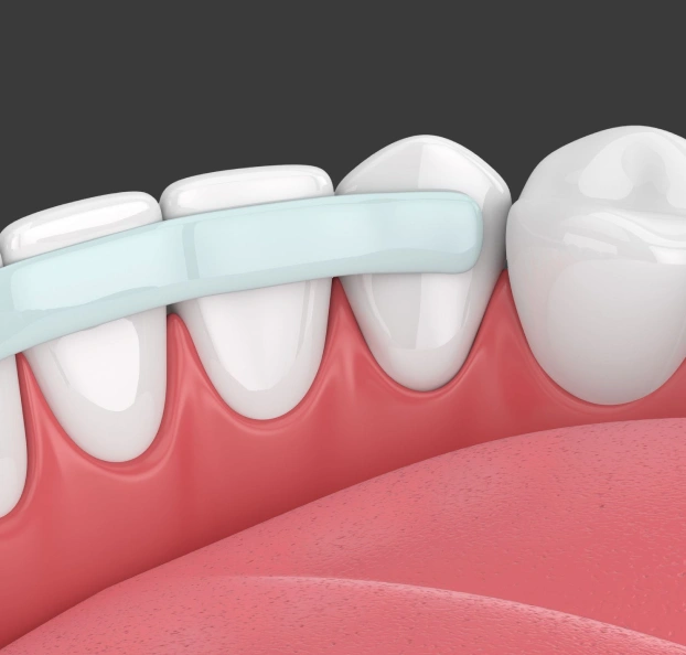 3D medical illustration showing composite bonding resin applied to the front surface of a lower tooth.