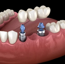 3D illustration showing a dental bridge being fitted onto two dental implant posts anchored directly into the jawbone.