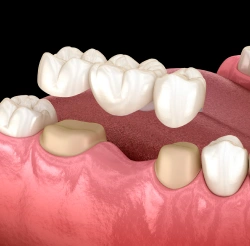 3D illustration showing a traditional dental bridge being fitted over two reshaped natural teeth adjacent to a missing tooth gap.