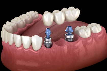 3D illustration showing a multi-tooth dental bridge attaching to two implant posts anchored in the jawbone.