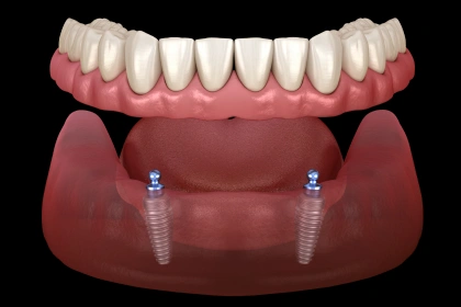 3D illustration showing a full set of lower dentures aligning over two dental implants anchored in the jawbone.
