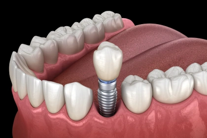 3D illustration of a single dental crown placing onto an implant post anchored in the jawbone between natural teeth.